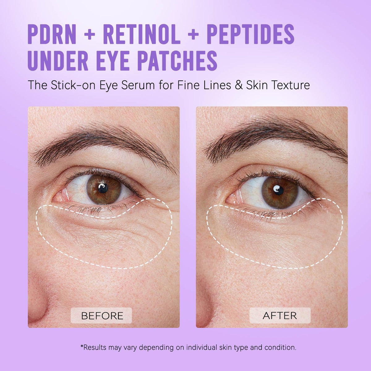 AILEORY PDRN Retinol Peptides Under Eye Patches in spa setting