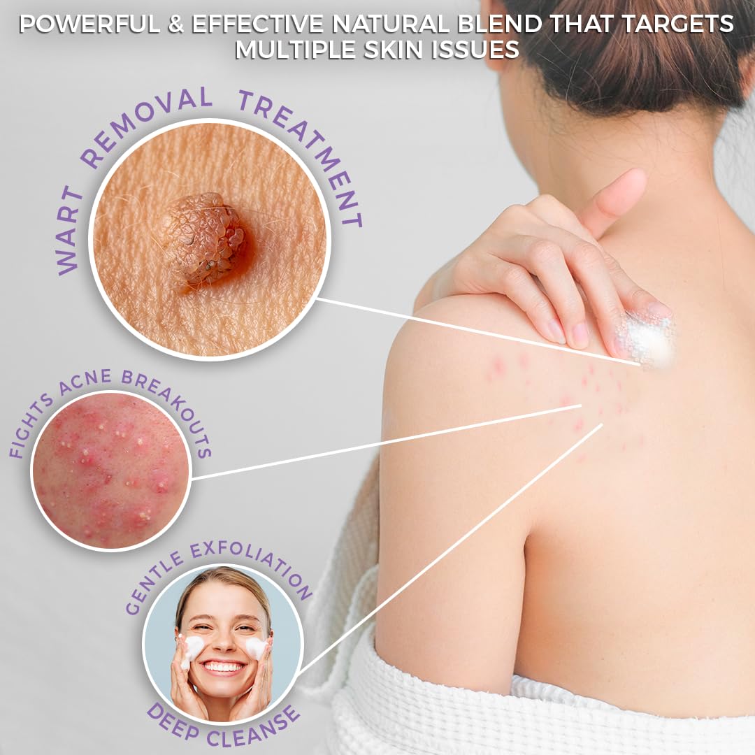Angel's Skin Natural Wart Remover Soap showing bar texture