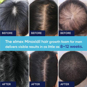 Artimore 5% Minoxidil Foam close-up of nozzle