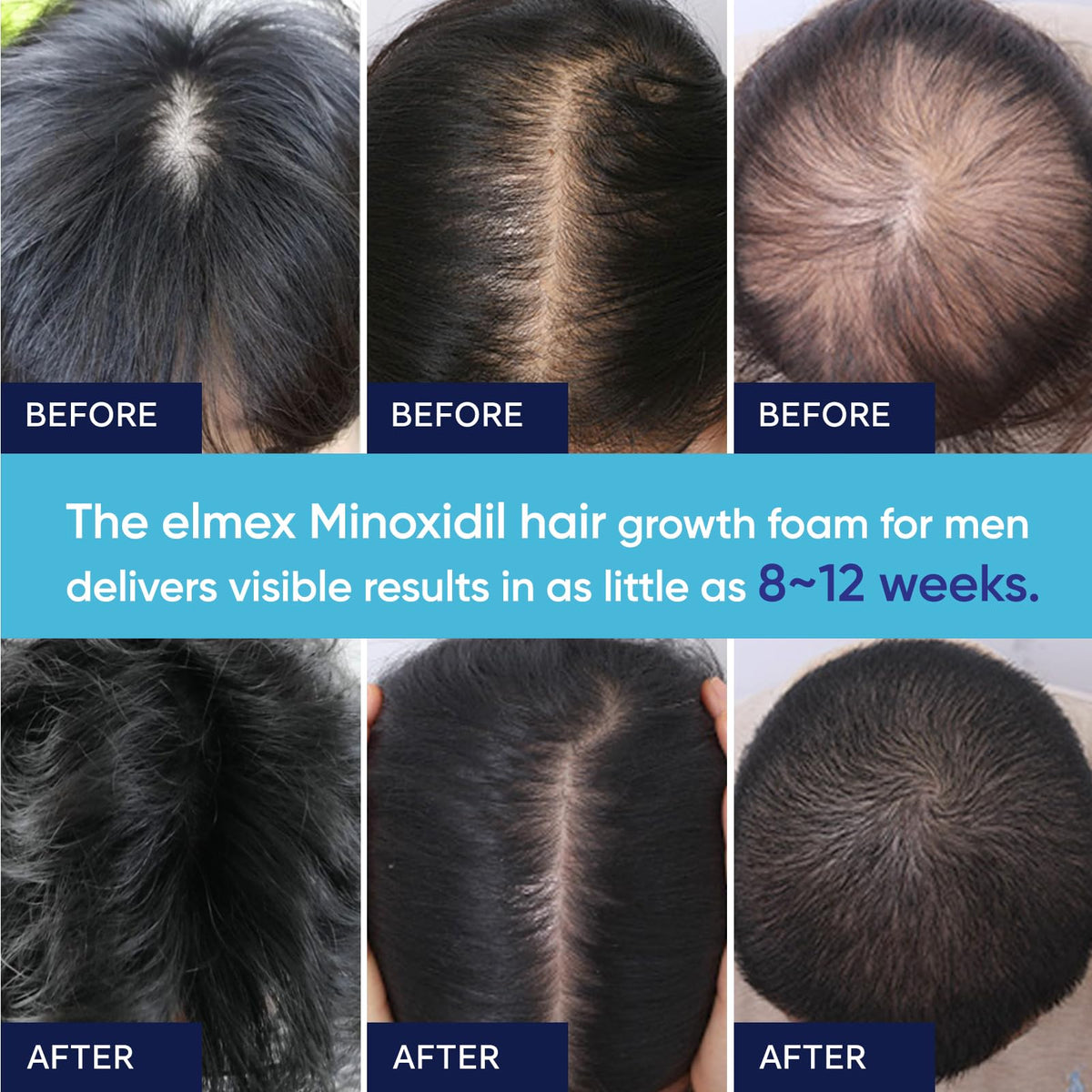 Artimore 5% Minoxidil Foam lifestyle scene on bathroom shelf