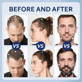 Artimore Minoxidil serum application on scalp