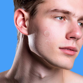 AVARELLE Acne Cover Patches in use