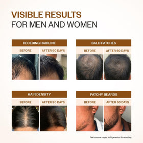 Bare Anatomy Advanced Hair Growth Serum with natural ingredients