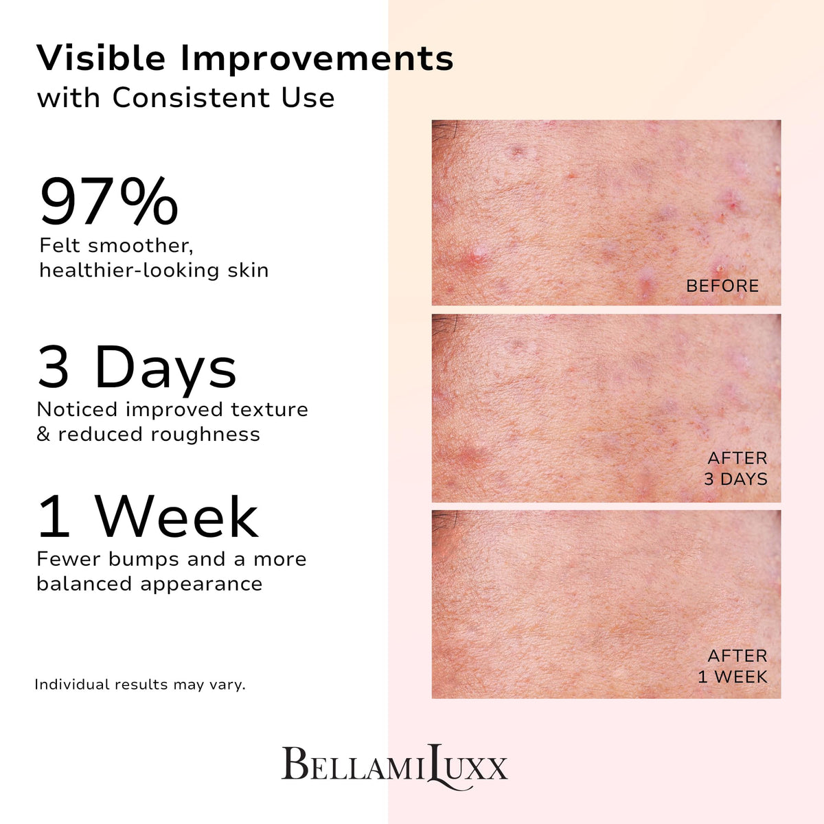 BellamiLuxx Butt Acne Lotion bottle with pump