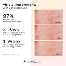 BellamiLuxx Butt Acne Lotion bottle with pump