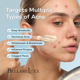BellamiLuxx Cystic Acne Cream application on skin