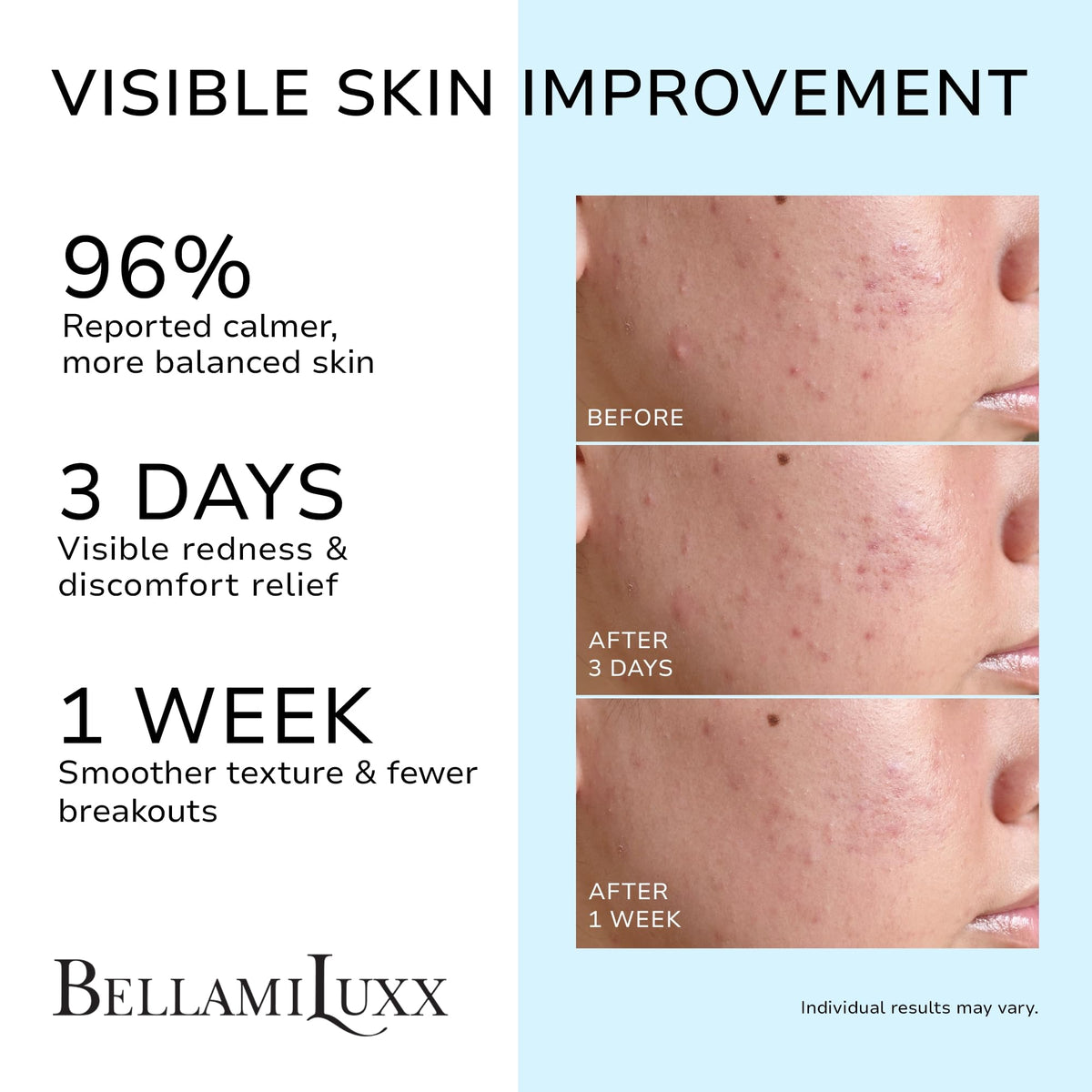 BellamiLuxx Cystic Acne Cream packaging