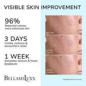 BellamiLuxx Cystic Acne Cream packaging