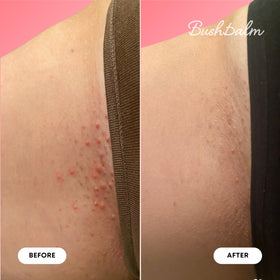 Bushbalm Ingrown Hair Oil 30ml with watermelon slices