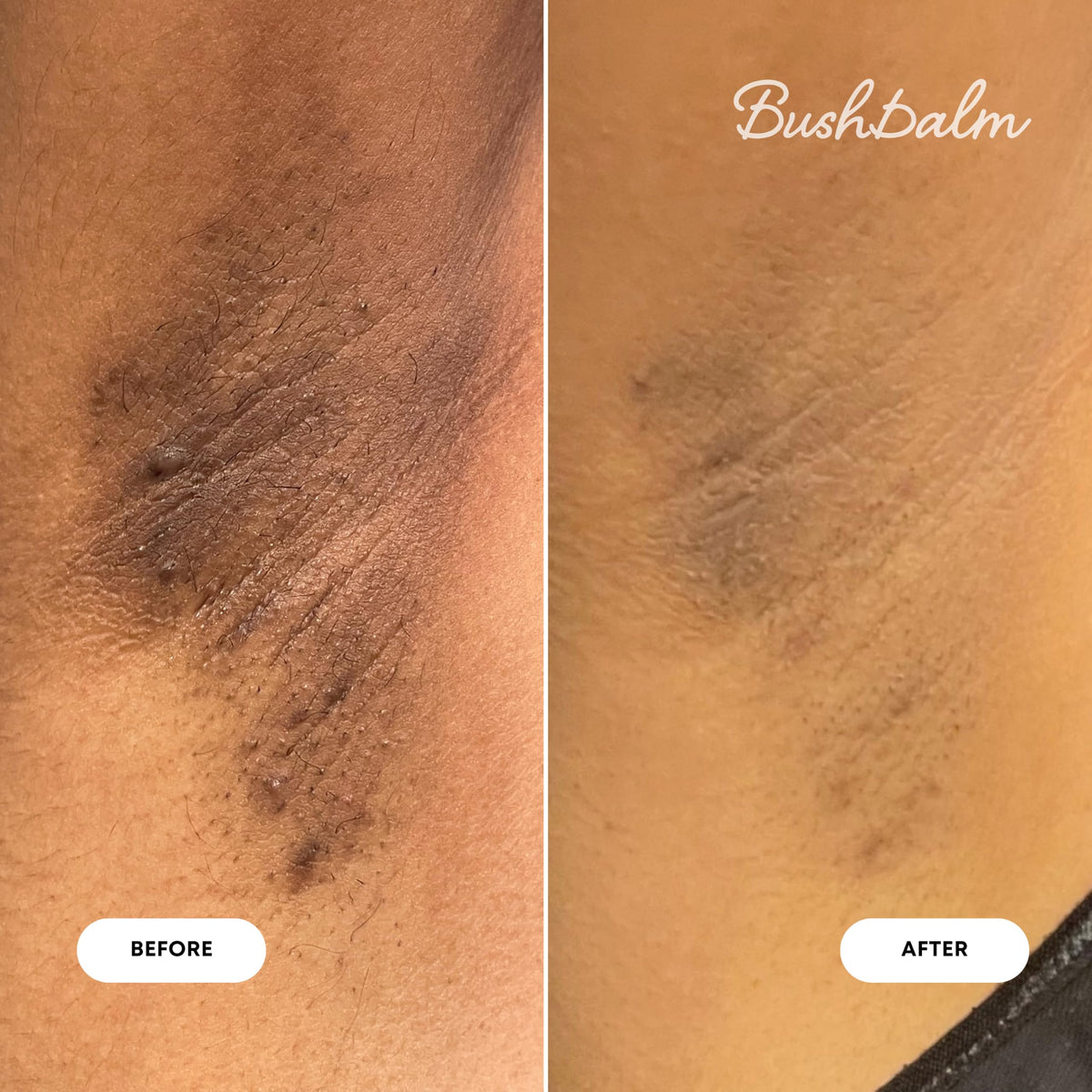 Bushbalm Ingrown Hair Oil close-up showing dropper