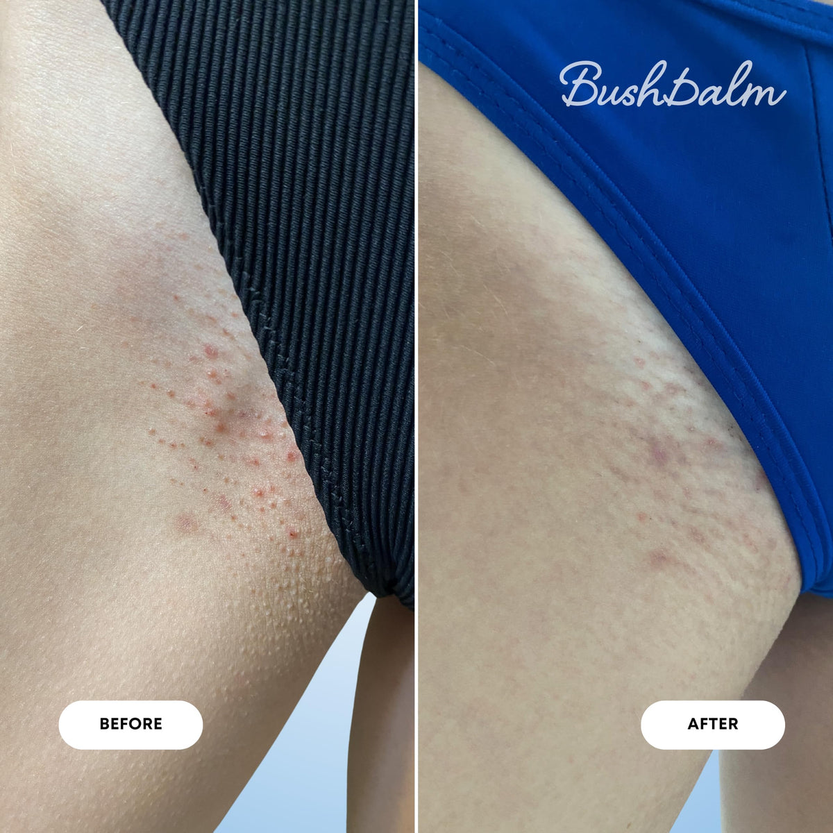 Bushbalm oil application on skin