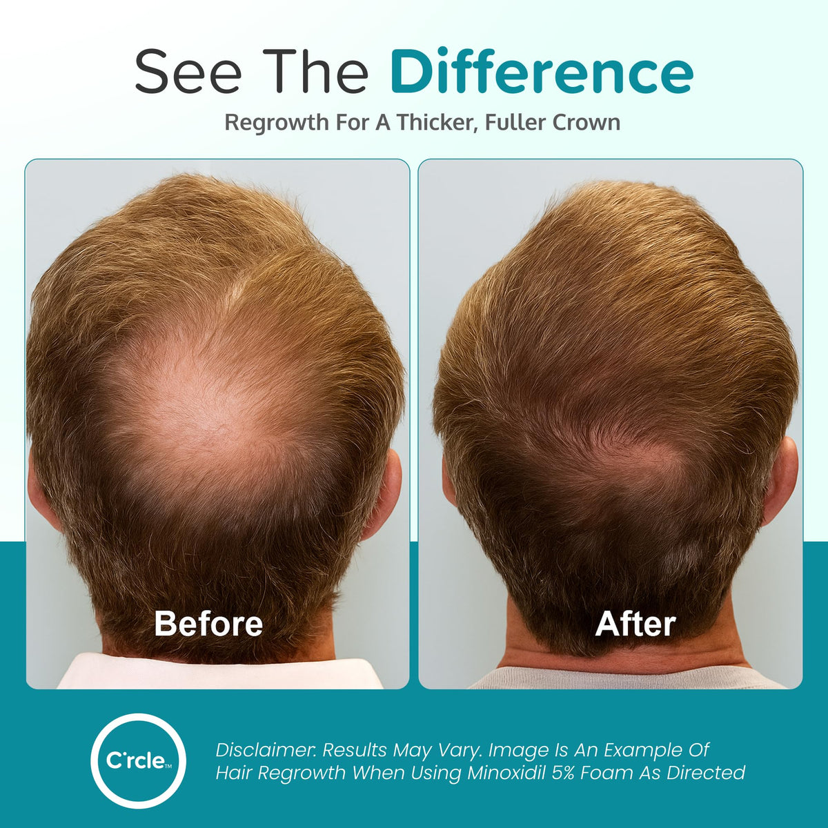 C'rcle Minoxidil Foam 5% top view