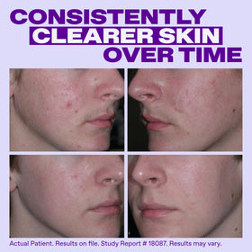 Close-up of Differin Epiduo Acne Gel pump