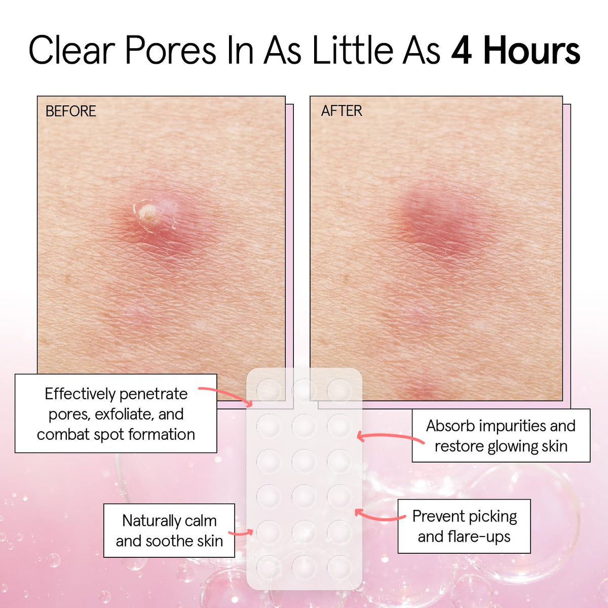 close-up of grace & stella pimple patches on skin
