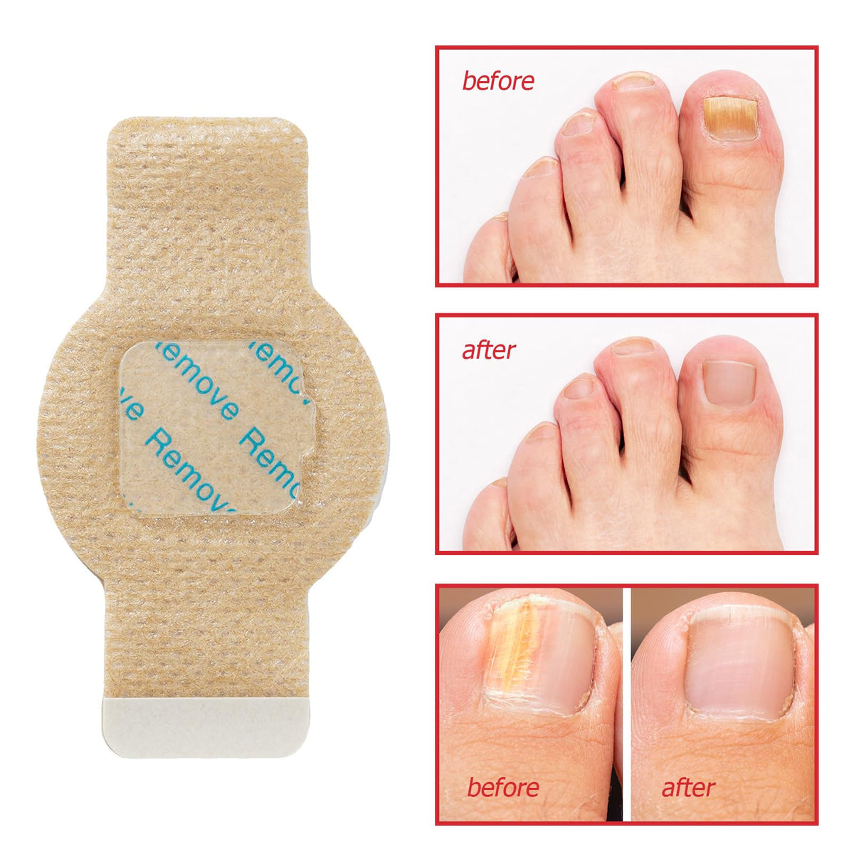 Close-up of LTQXGT Toenail Care Patches showing self-adhesive design
