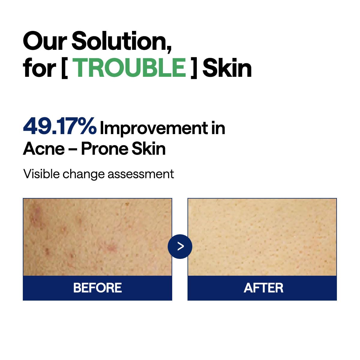 Close-up of MEDIHEAL Toner Pad with tea tree extract