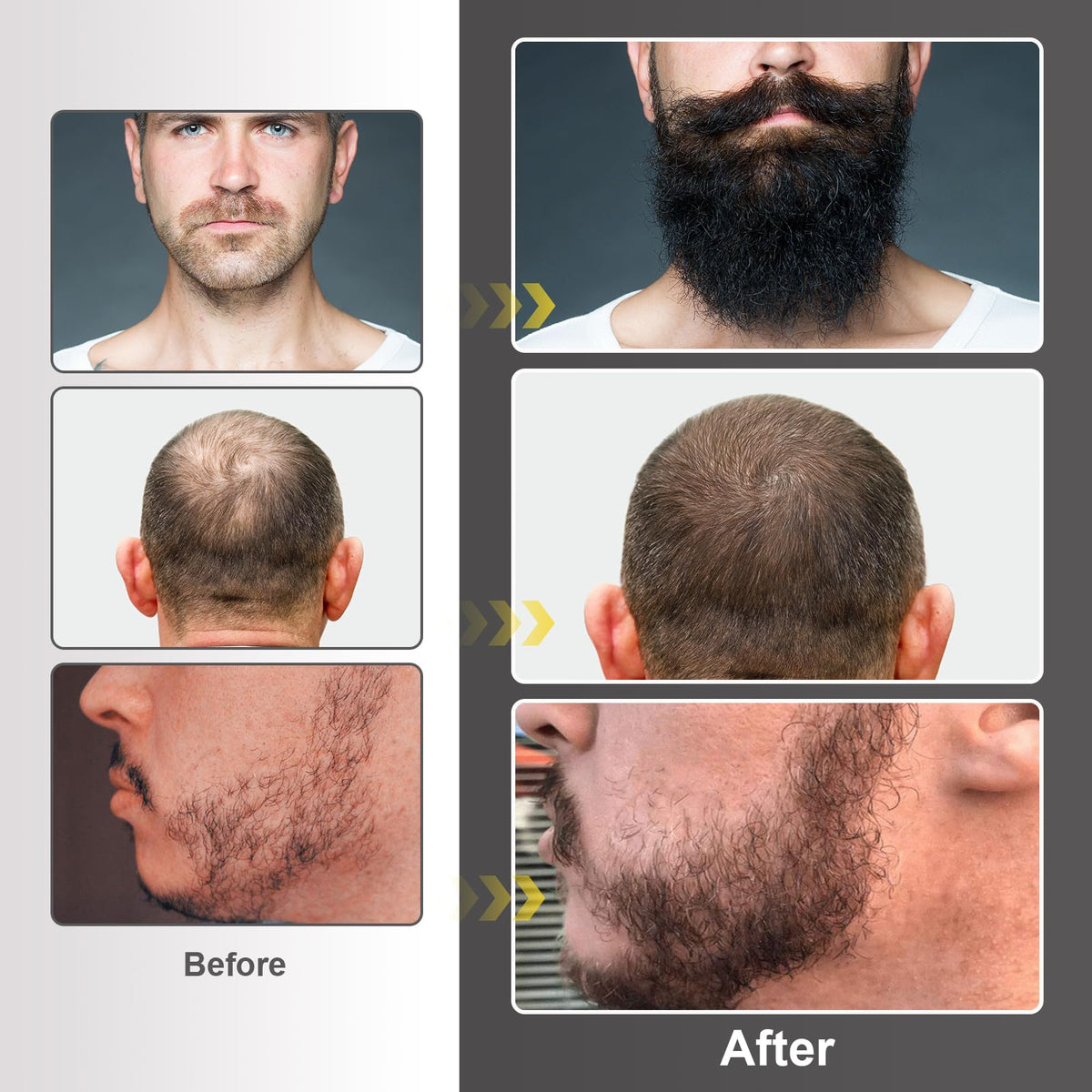 Close-up of Naland Beard Growth Kit packaging