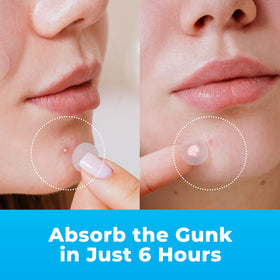 Close-up of PatchRx hydrocolloid acne patches