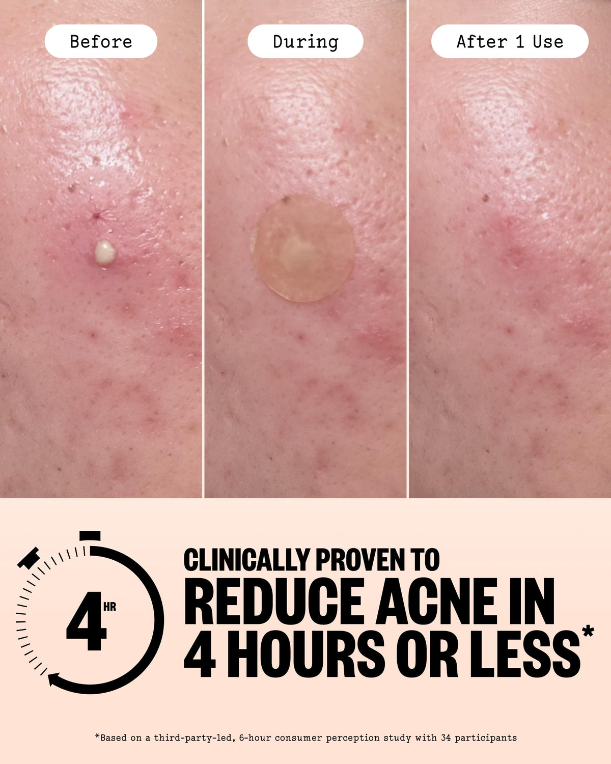 Close-up of PEACE OUT Acne Healing Dots on a blemish