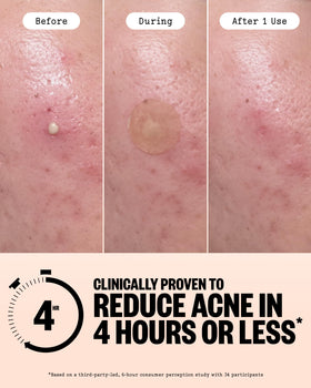 Close-up of PEACE OUT Acne Healing Dots patch