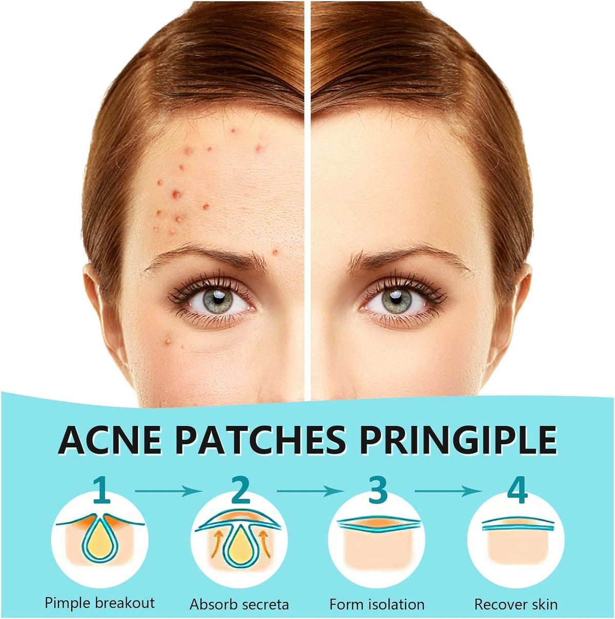 Close-up of PICcircuit Hydrocolloid Pimple Patches on skin