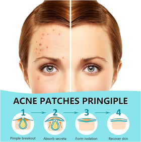 Close-up of PICcircuit Hydrocolloid Pimple Patches on skin