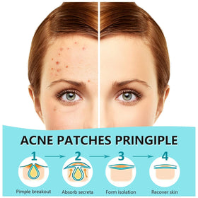 Close-up of PICcircuit Pimple Patches on skin