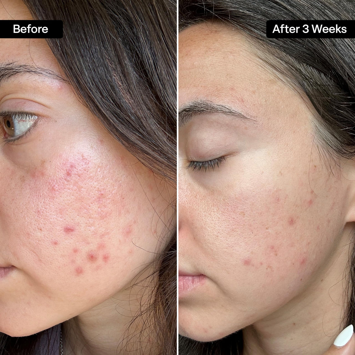 Close-up of QRxLabs Salicylic & Glycolic Acid Pads