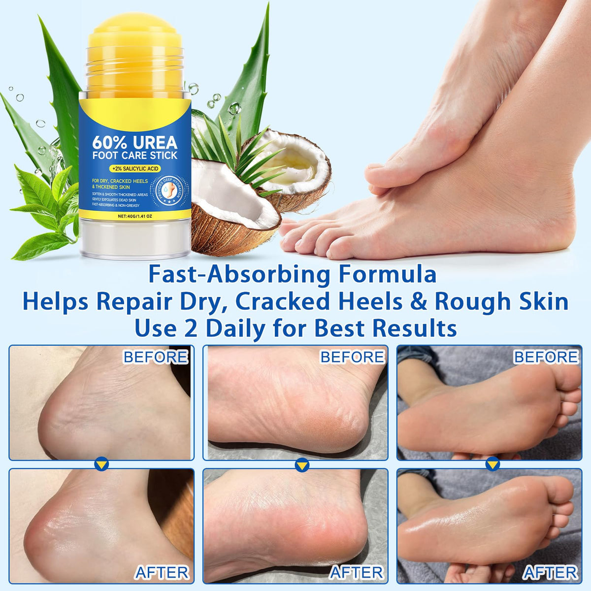 Close-up of the stick application of 60% Urea Cream