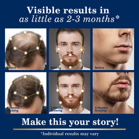 DAAZZS 5% Minoxidil spray nozzle close-up