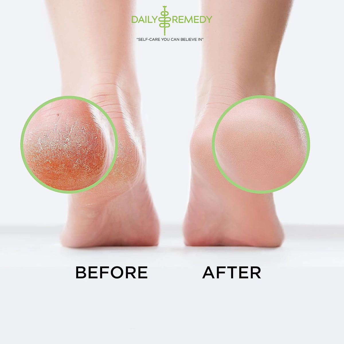DAILY REMEDY Tea Tree Oil Foot Soak with relaxing spa setup