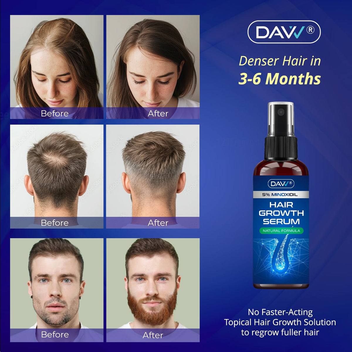 DAVV 5% Minoxidil Spray back view