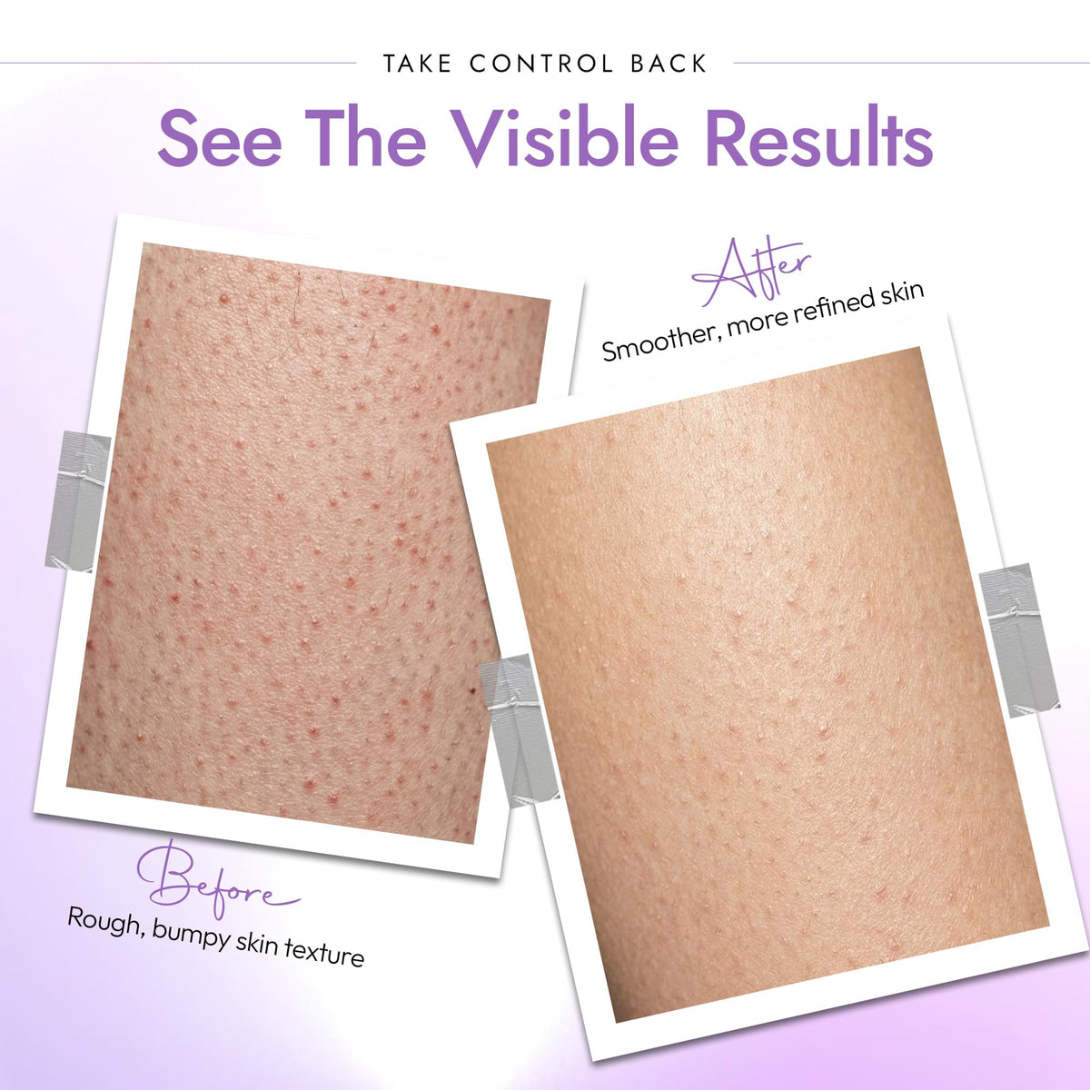 DERMAdoctor KP Bump Eraser Body Scrub application on skin
