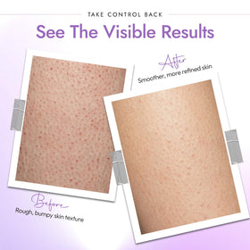 DERMAdoctor KP Bump Eraser Body Scrub application on skin