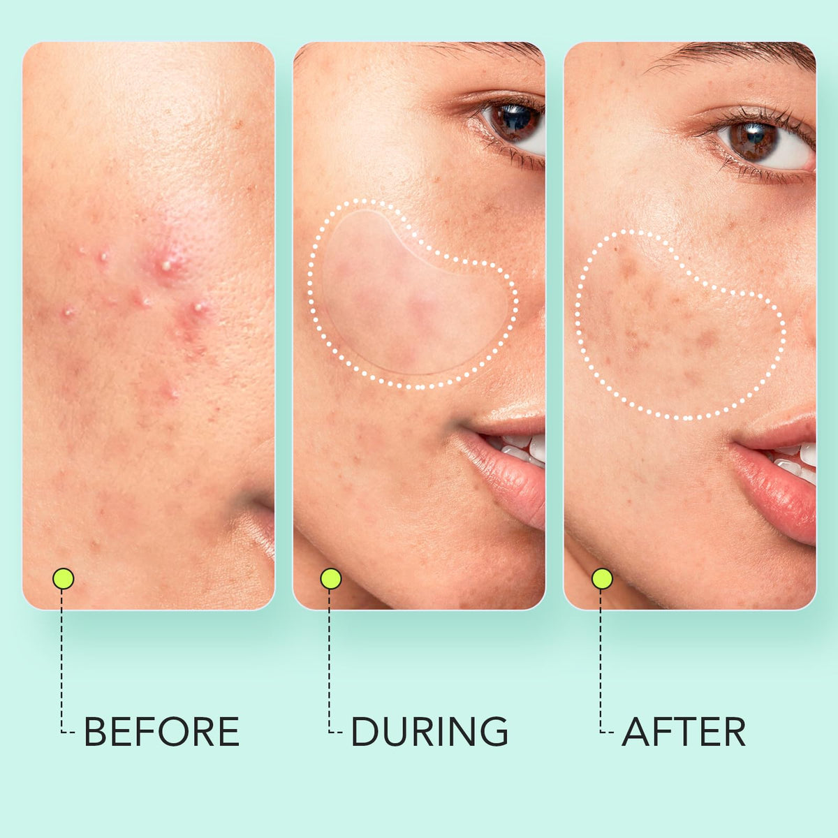 Different sizes of LitBear Pimple Patches displayed