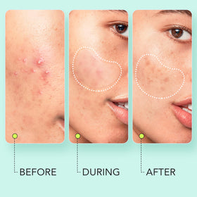 Different sizes of LitBear Pimple Patches displayed