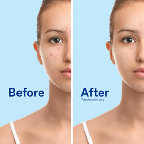 Differin Acne Face Wash 10% Benzoyl Peroxide foam texture