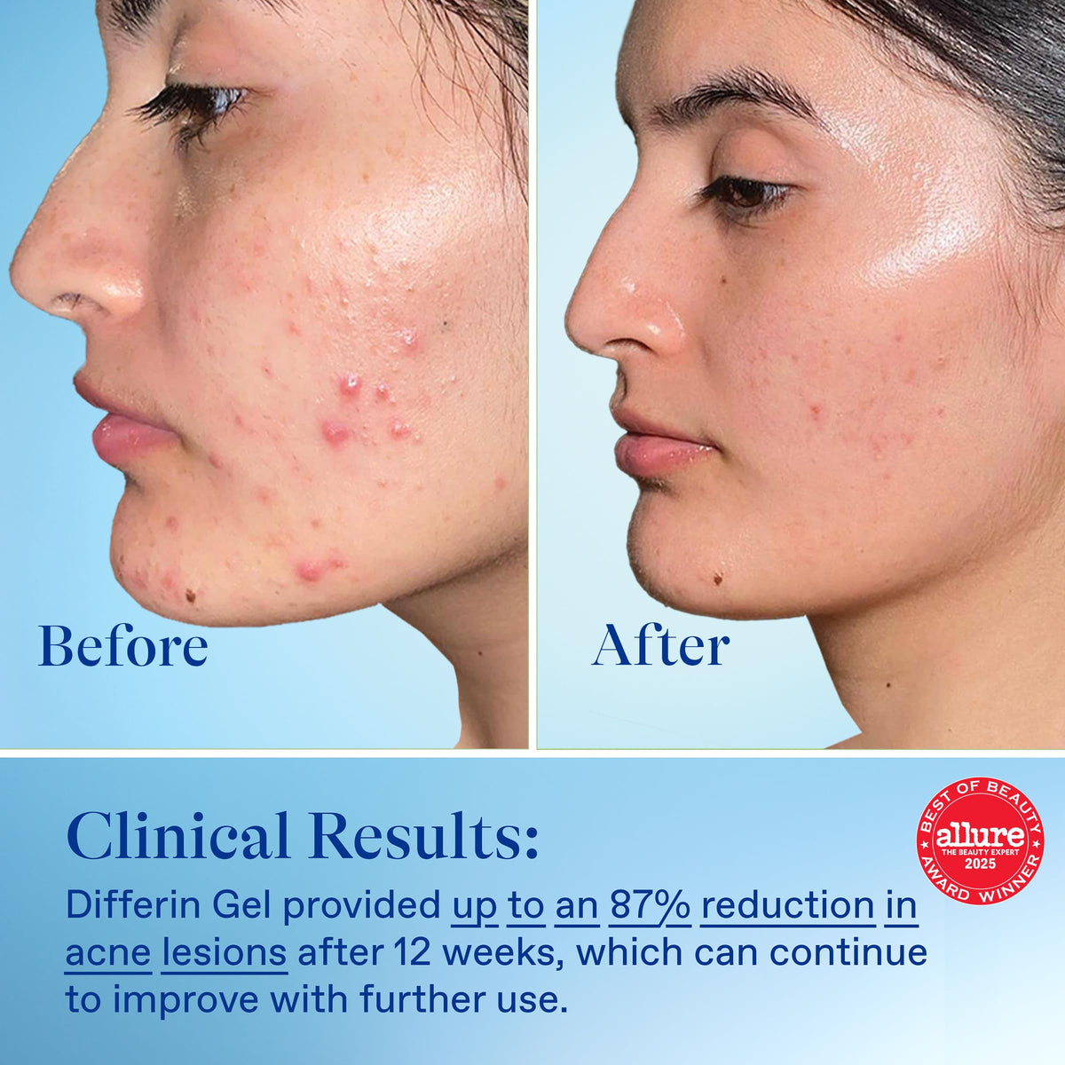 Differin Acne Gel 2ct pack display