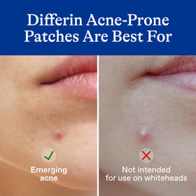 Differin Acne Pimple Patches small patch on skin