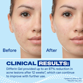 Differin Gel application on skin texture