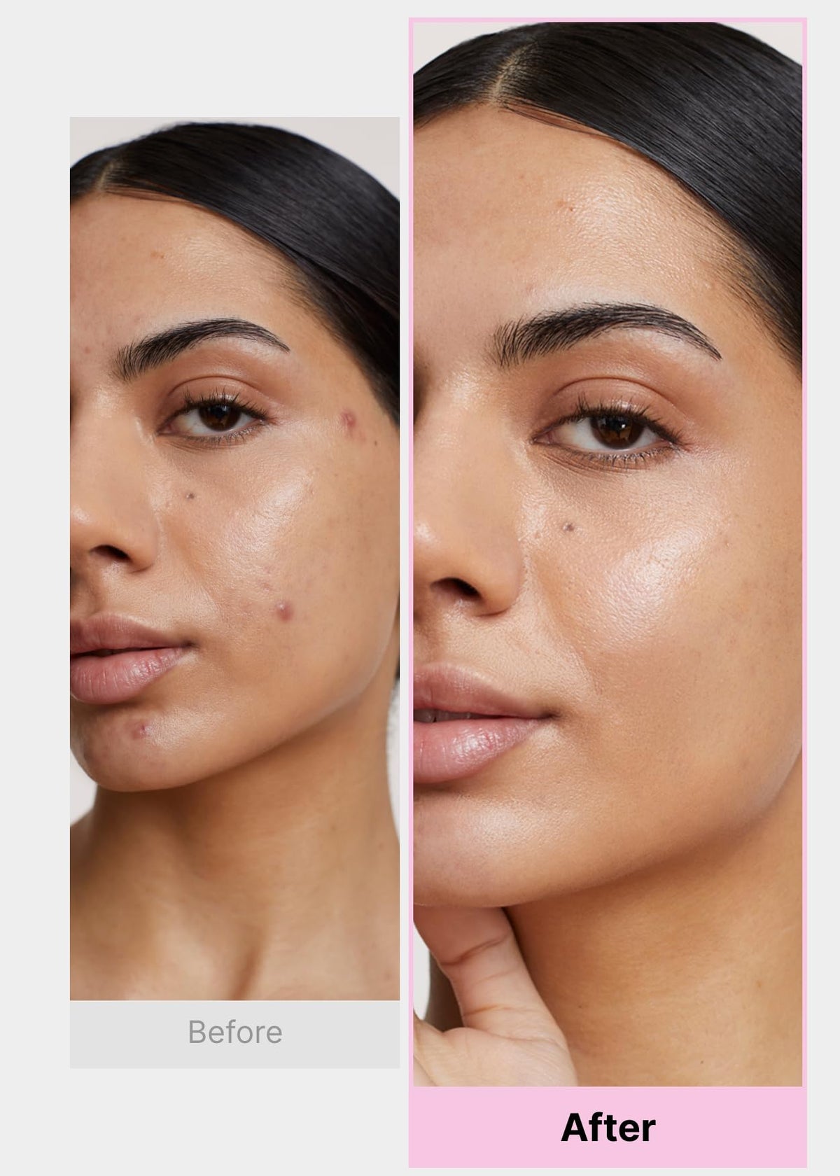 DWEasyDerm Pimple Patch in use on a blemish