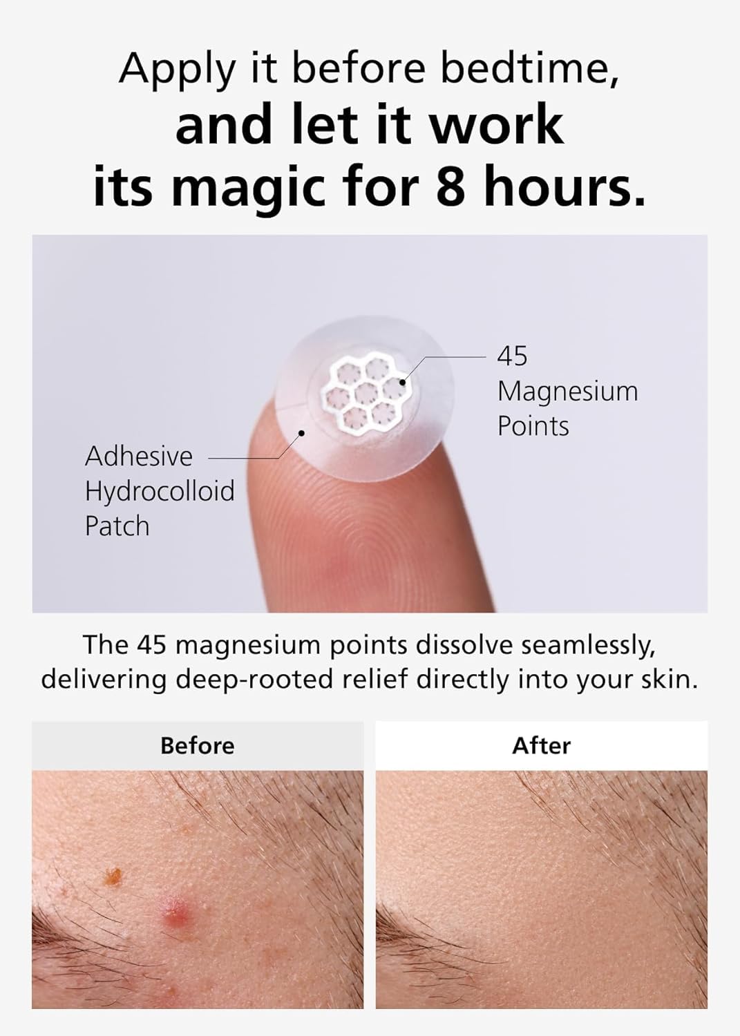DWEasyDerm Quick Microdart Pimple Patch in use on skin