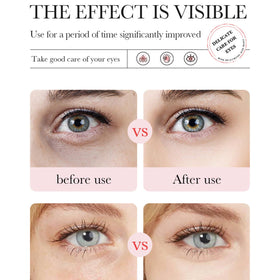 Eakroo Rose Eye Mask applied on under eyes
