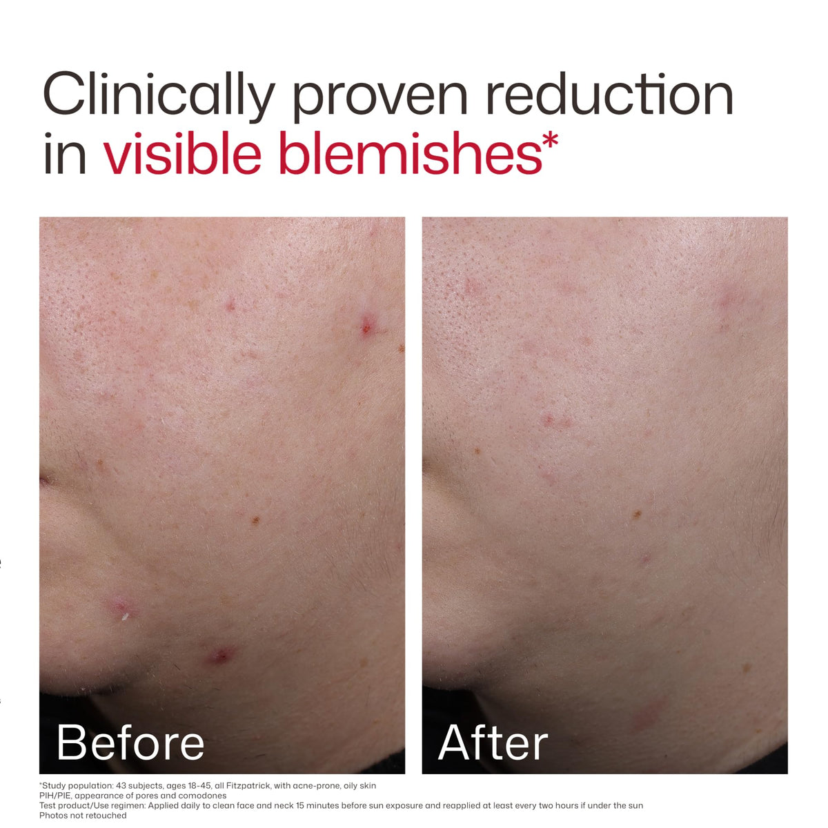 EltaMD UV Clear Blemish-Prone SPF 50 with makeup