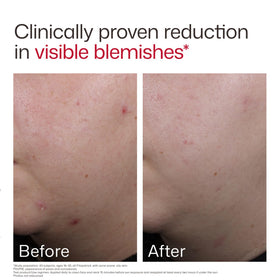 EltaMD UV Clear Blemish-Prone SPF 50 with makeup
