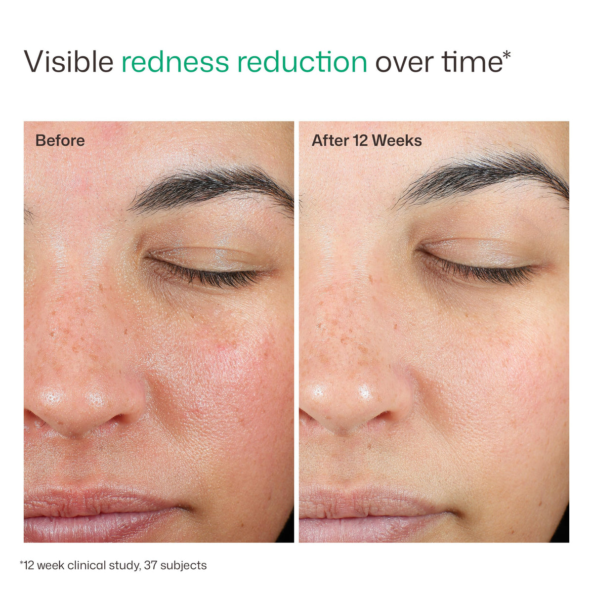EltaMD UV Skin Recovery Green Tinted Mineral Sunscreen SPF 50 lifestyle use