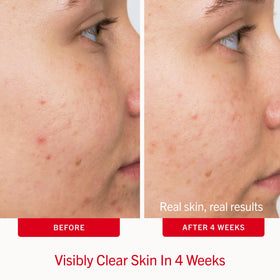 First Aid Beauty Acne Pads open container