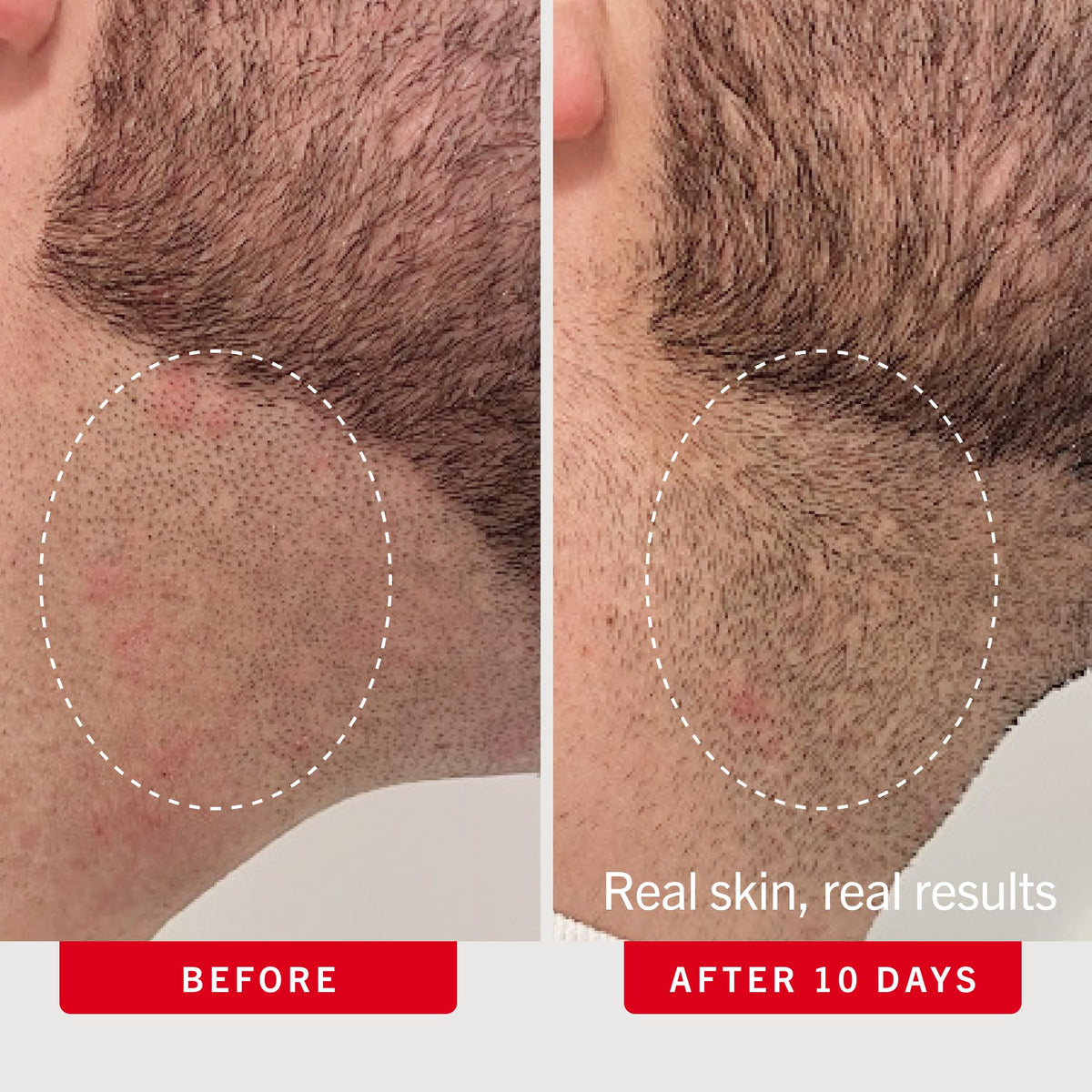 First Aid Beauty Ingrown Hair Pads next to shaving accessories