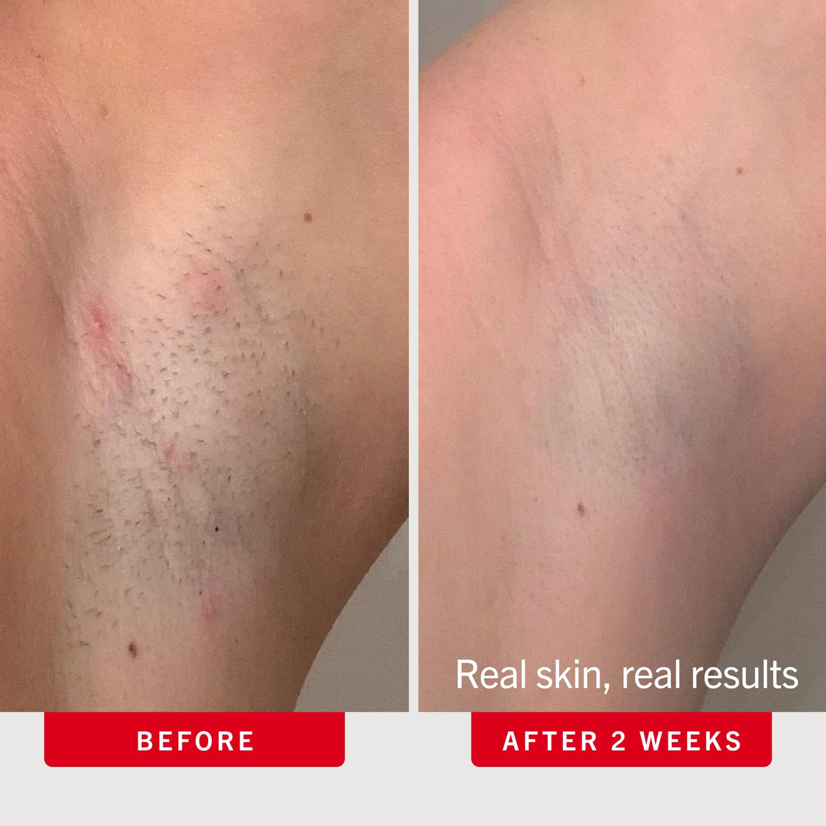 First Aid Beauty Ingrown Hair Pads on a bathroom counter