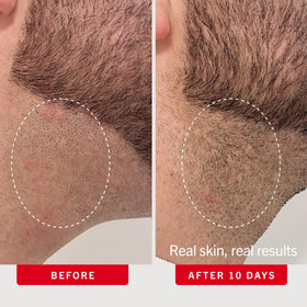 First Aid Beauty Ingrown Hair Pads with background skincare products